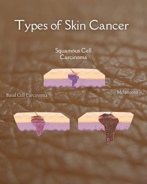 how spot skin cancer, types of skin cancer