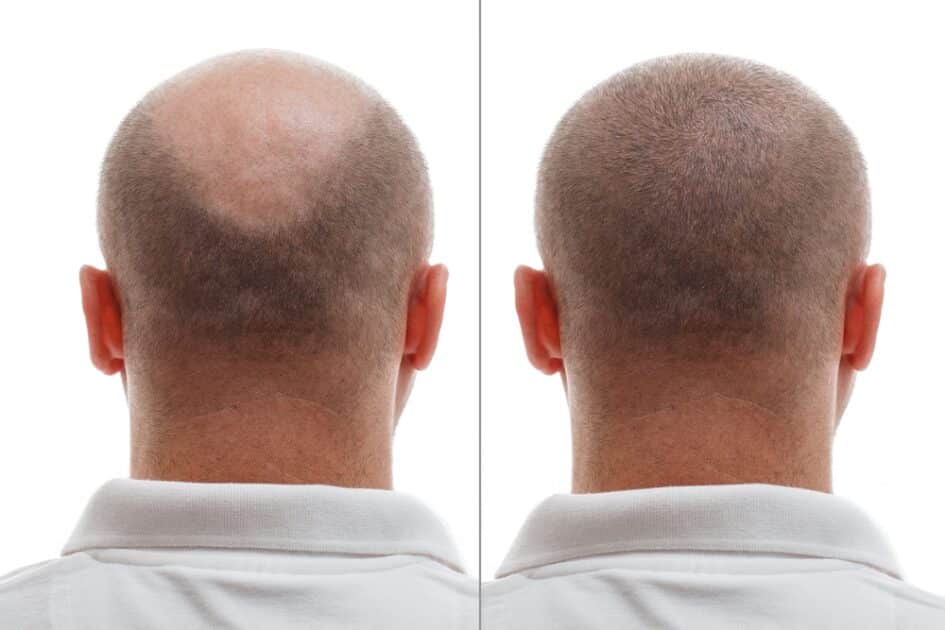 Hair Loss After Surgery 