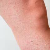 How to Get Rid of Strawberry Legs? Tips and Tricks for Strawberry Skin