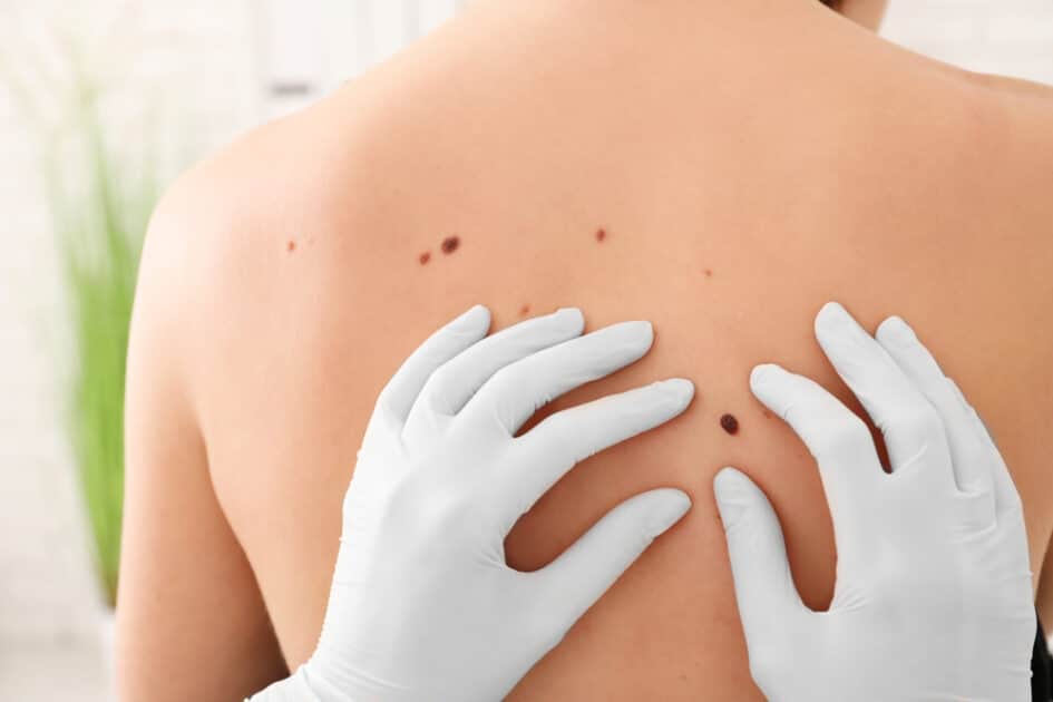 Risk Factors for Skin Cancer