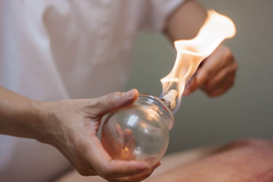Woman heating a glass cup for cupping therapy, a treatment.